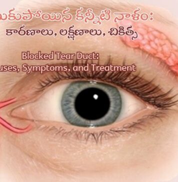 మూసుకుపోయిన కన్నీటి నాళం: కారణాలు, లక్షణాలు, చికిత్స Blocked Tear Duct_ Causes, Symptoms, and Treatment