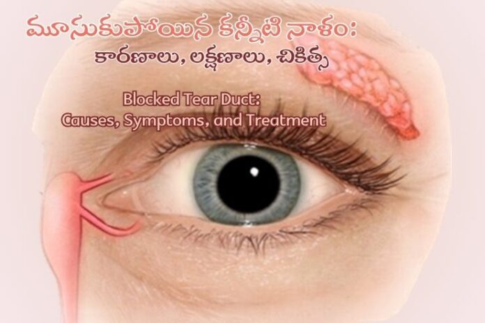 Blocked Tear Duct_ Causes, Symptoms, and Treatment Blocked Tear Duct_ Causes, Symptoms, and Treatment