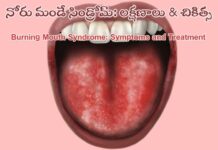 నోరు మంట సిండ్రోమ్: కారణాలు, లక్షణాలు, నివారణ Burning mouth syndrome_ Symptoms and Treatment