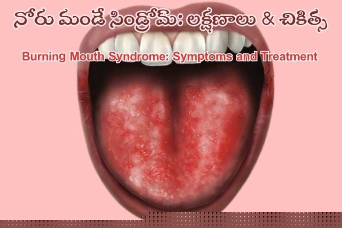 Burning mouth syndrome_ Symptoms and Treatment