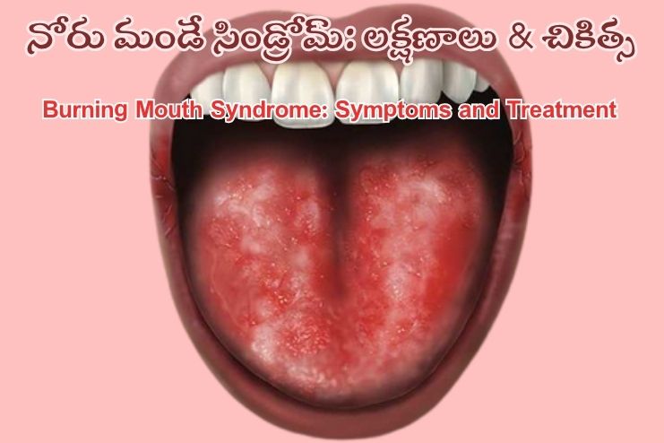 నోరు మంట సిండ్రోమ్: కారణాలు, లక్షణాలు, నివారణ Burning mouth syndrome_ Symptoms and Treatment