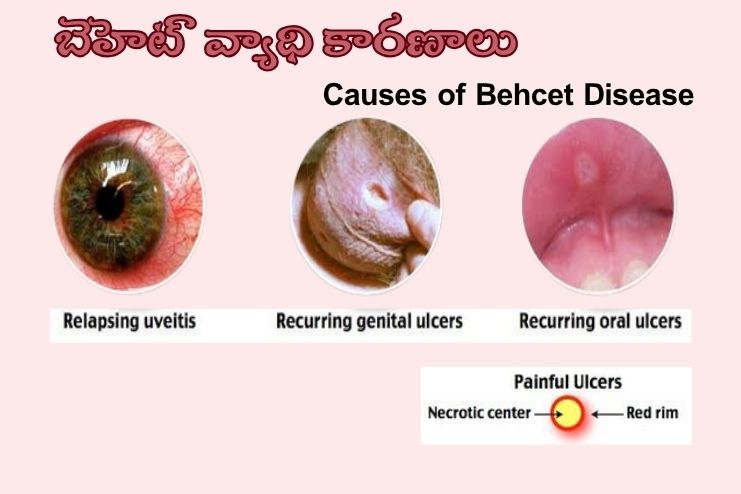 Causes