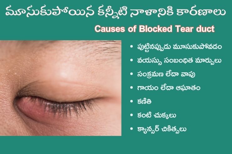 Causes of Blocked Tear duct