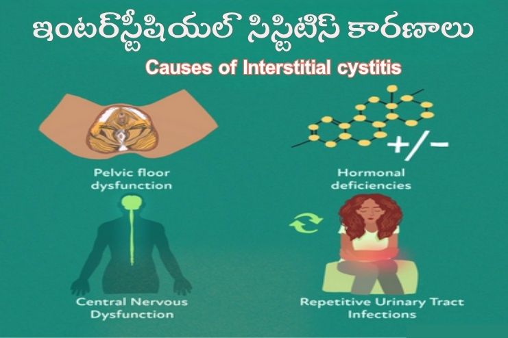 Causes of Interstitial cystitis