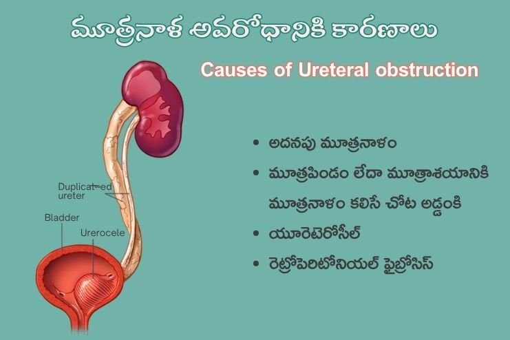 Causes of Ureteral obstruction