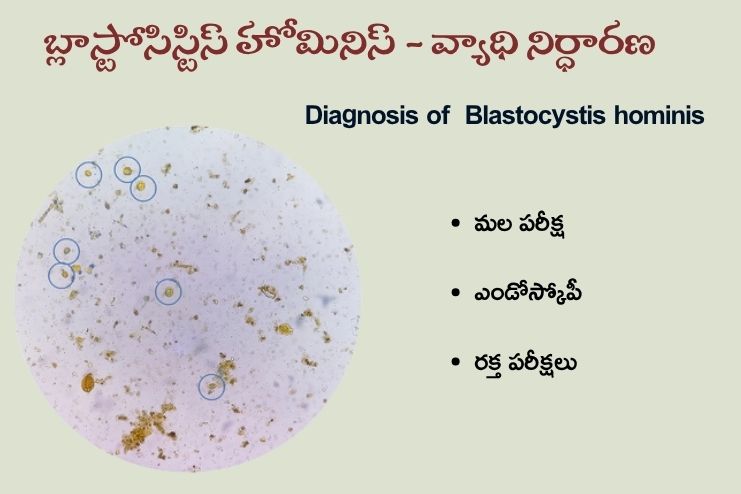 Diagnosis of Blastocystis hominis