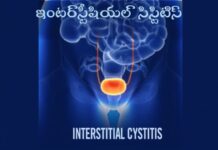 ఇంటర్స్టీషియల్ సిస్టిటిస్: కారణాలు, లక్షణాలు, నివారణ Interstitial cystitis_ Causes, Symptoms