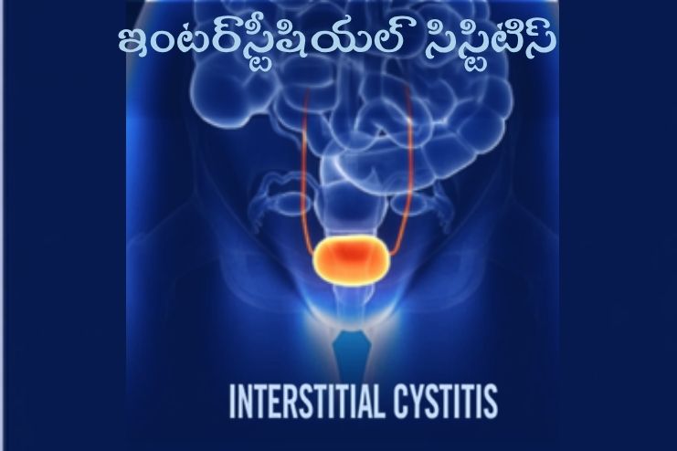 ఇంటర్స్టీషియల్ సిస్టిటిస్: కారణాలు, లక్షణాలు, నివారణ Interstitial cystitis_ Causes, Symptoms