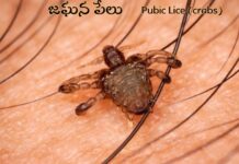 జఘన పేలు: కారణాలు, లక్షణాలు, చికిత్సలు Pubic Lice (crabs)