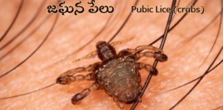జఘన పేలు: కారణాలు, లక్షణాలు, చికిత్సలు - Pubic Lice: Causes, Symptoms and Treatments Pubic Lice (crabs)