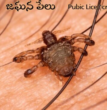జఘన పేలు: కారణాలు, లక్షణాలు, చికిత్సలు Pubic Lice (crabs)