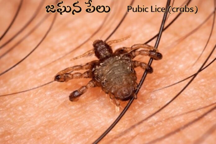 Pubic Lice (crabs) Pubic Lice (crabs)