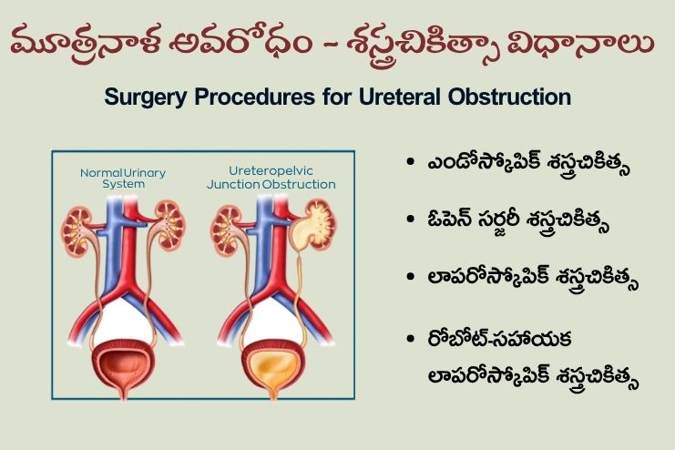 Surgery Procedures for Ureteral obstruction