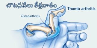 Thumb Arthritis_ Causes, Symptoms and Treatments