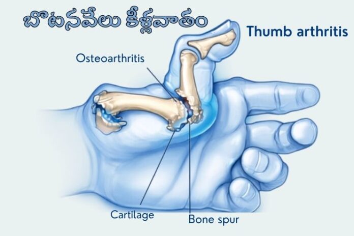 Thumb Arthritis_ Causes, Symptoms and Treatments