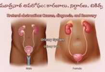 మూత్రనాళ అవరోధం: కారణాలు, లక్షణాలు, చికిత్స Ureteral obstruction_ Causes, diagnosis, and Recovery