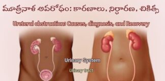 మూత్రనాళ అవరోధం: కారణాలు, లక్షణాలు, చికిత్స - Ureteral Obstruction: Causes, Diagnosis, and Recovery Ureteral obstruction_ Causes, diagnosis, and Recovery