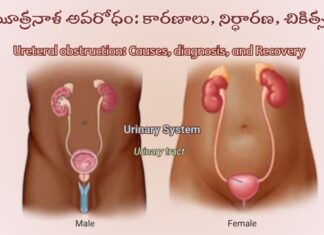 మూత్రనాళ అవరోధం: కారణాలు, లక్షణాలు, చికిత్స Ureteral obstruction_ Causes, diagnosis, and Recovery