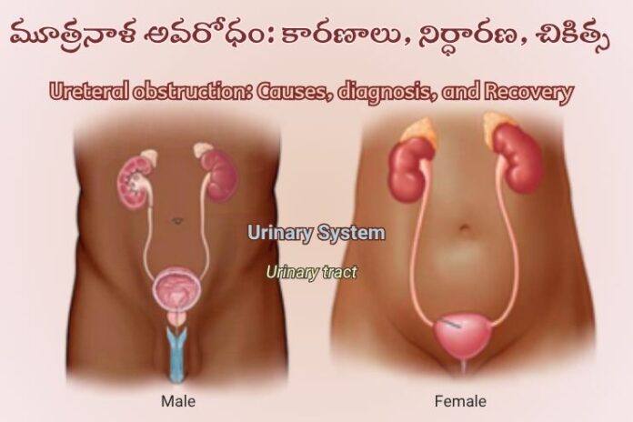 Ureteral obstruction_ Causes, diagnosis, and Recovery