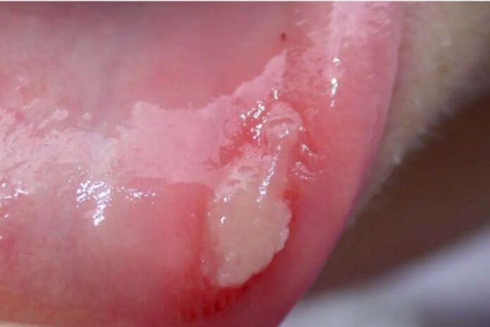 behcet disease symptoms and causes