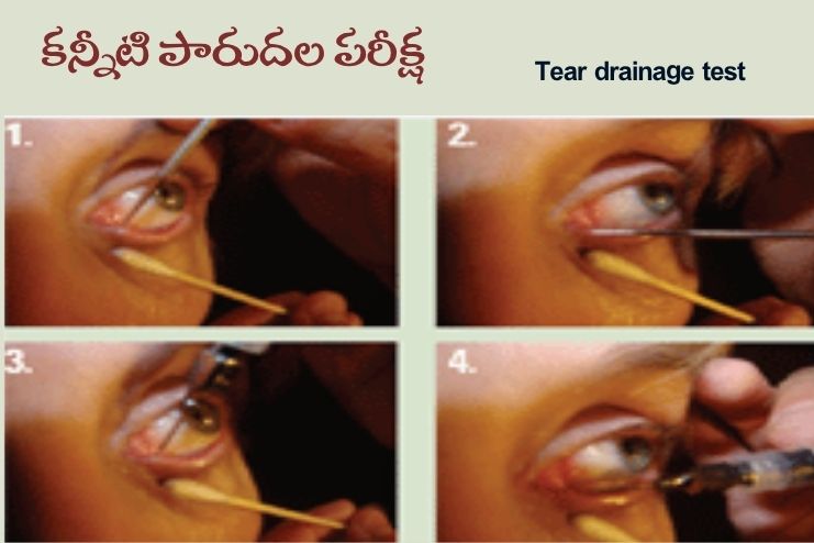 diagnosis- Tear drainage test