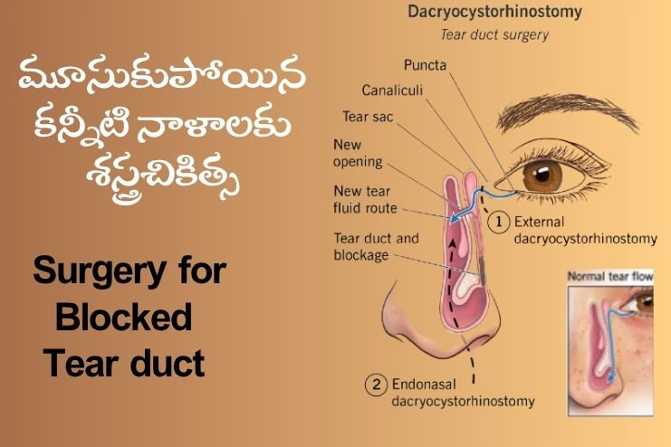 surgery-(external dacryocystorhinostomy